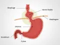 Schéma du diaphragme et de l'estomac montrant une hernie hiatale. Des remèdes de grand-mère peuvent aider à soulager les symptômes.