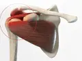 Anatomie de l'épaule montrant une tendinite. La zone rouge indique la douleur, suggérant un long temps de guérison.