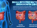Illustration comparant un intestin sain et un intestin infecté par SIBO, montrant les symptômes de la prolifération bactérienne.