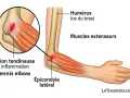 Illustration d'une tendinite du coude, aussi appelée "tennis elbow", montrant l'inflammation de l'épicondyle latéral.
