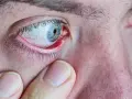 Gros plan sur un œil humain présentant un orgelet rouge sur la paupière. Une main touche doucement la zone, suggérant une recherche d'orgelet traitement naturel.