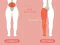Illustration montrant le nerf sciatique et la zone douloureuse. Comprendre comment soigner une sciatique est essentiel pour retrouver le confort.