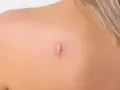 Une cicatrice hypertrophique, rouge et surélevée, est visible sur l'épaule d'une personne.