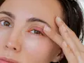 Un orgelet sur la paupière, peut-être causé par la fatigue, rend le regard moins vif.