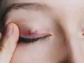 Un chalazion rouge et enflammé sur la paupière, causant une fatigue visuelle.
