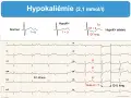 Électrocardiogramme montrant une hypokaliémie sévère avec onde U > T et QT long, signes d'un manque de potassium.