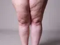 Jambes présentant des signes de lipœdème, évoquant la recherche d'un lipœdème traitement naturel.