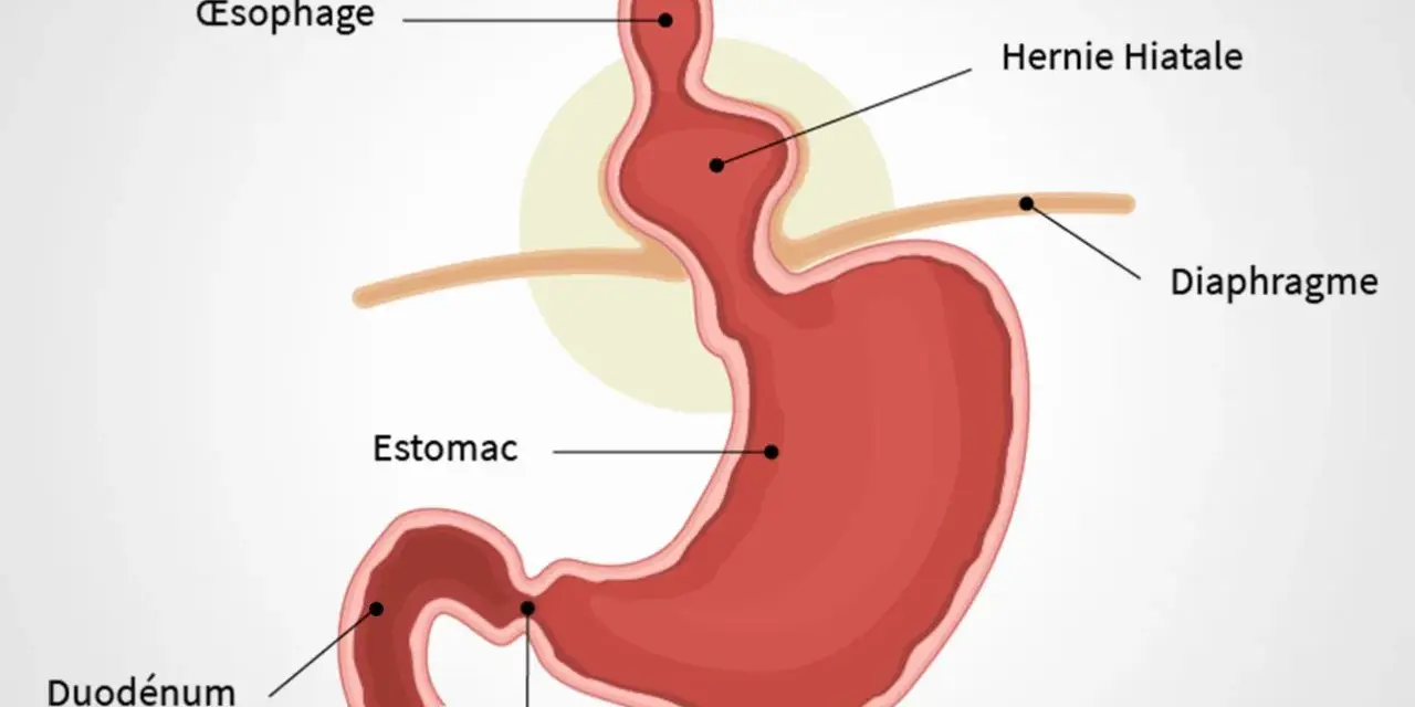 Schéma du diaphragme et de l'estomac montrant une hernie hiatale. Des remèdes de grand-mère peuvent aider à soulager les symptômes.