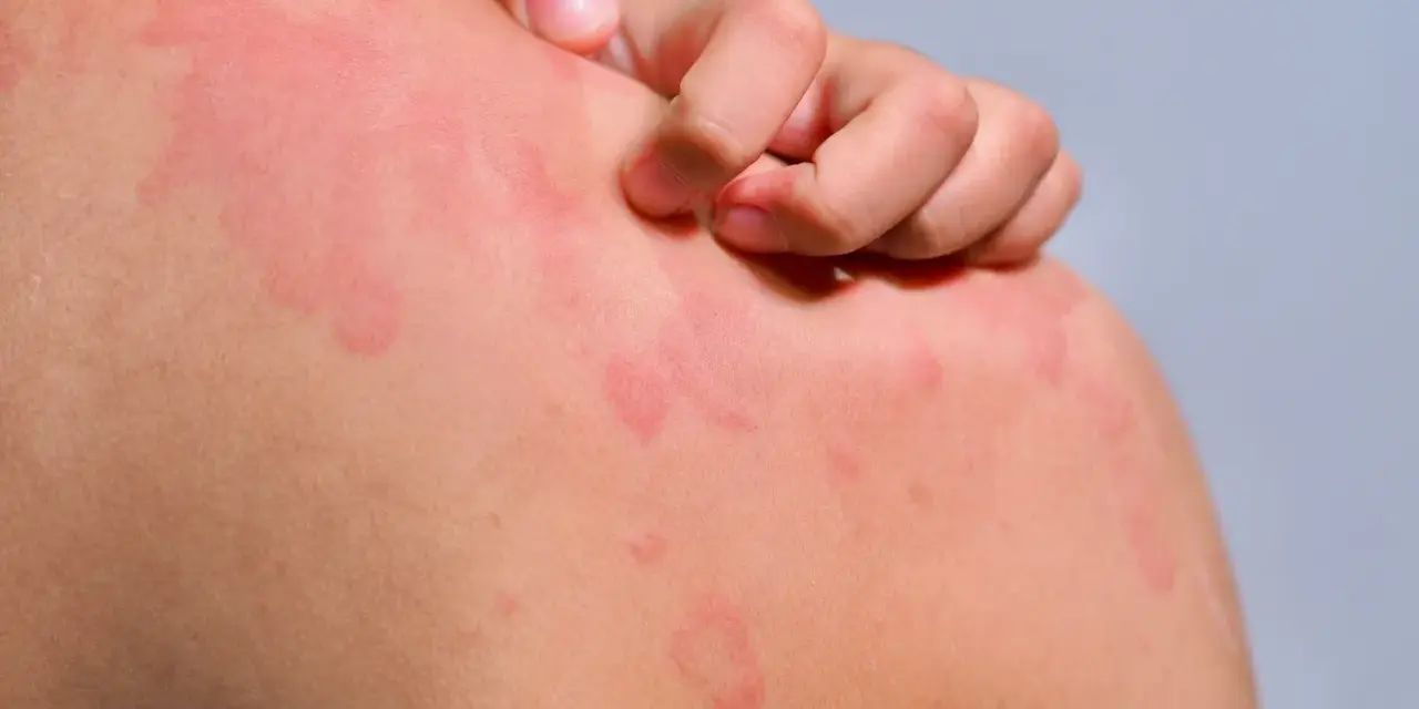 Une personne se gratte l'épaule couverte de plaques rouges, signe d'urticaire chaleur.