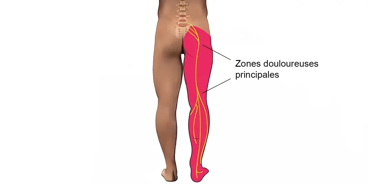 Schéma montrant les zones douloureuses principales dans la jambe et la cuisse, le long des nerfs sciatiques.