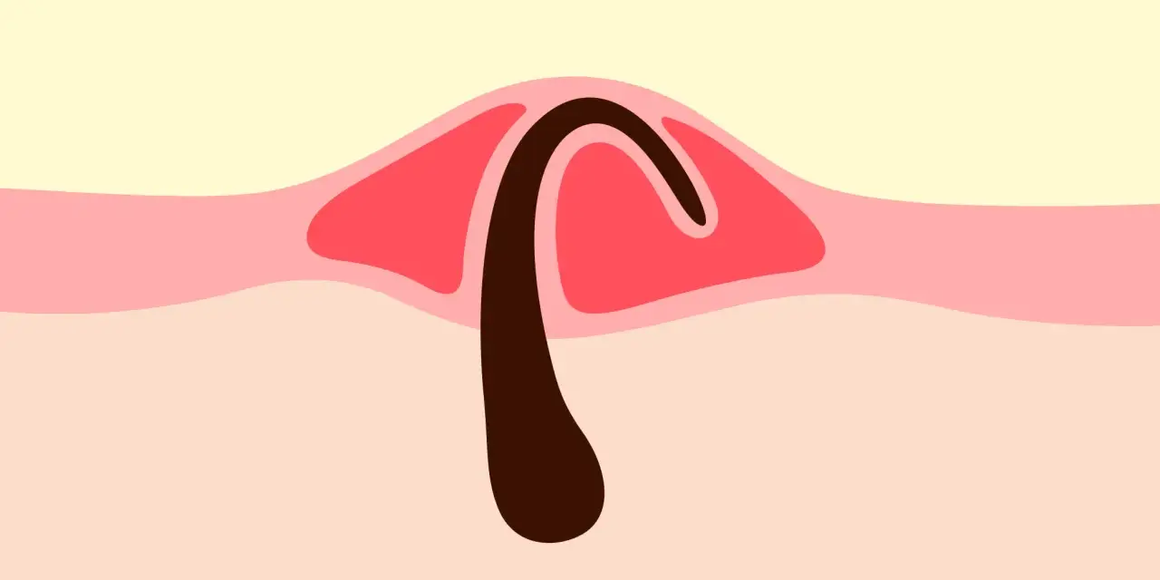 Illustration d'un poil incarné sous la peau, avec une partie foncée courbée sous une couche rose.