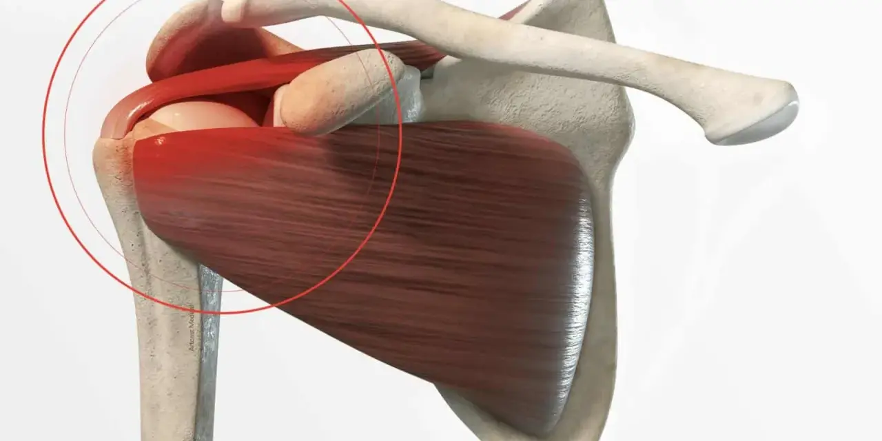 Anatomie de l'épaule montrant une tendinite. La zone rouge indique la douleur, suggérant un long temps de guérison.