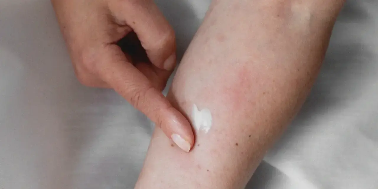 Application d'une crème apaisante sur une peau irritée, suggérant un urticaire traitement naturel.