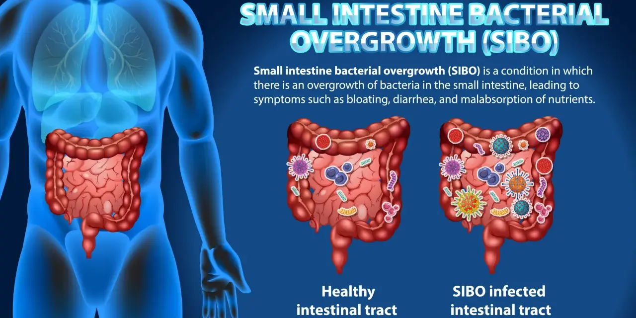 Illustration comparant un intestin sain et un intestin infecté par SIBO, montrant les symptômes de la prolifération bactérienne.