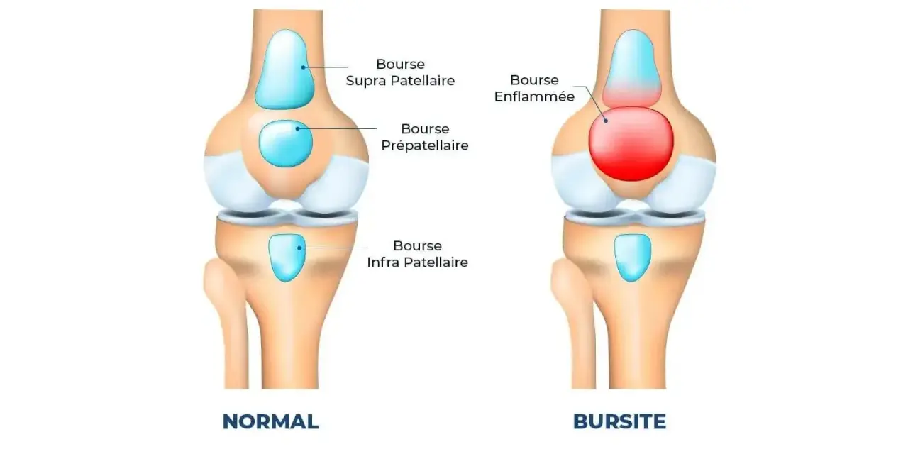 Comparaison d'un genou normal et d'un genou atteint de bursite. La bourse prépatellaire est enflammée et gonflée, causant un genou gonflé.