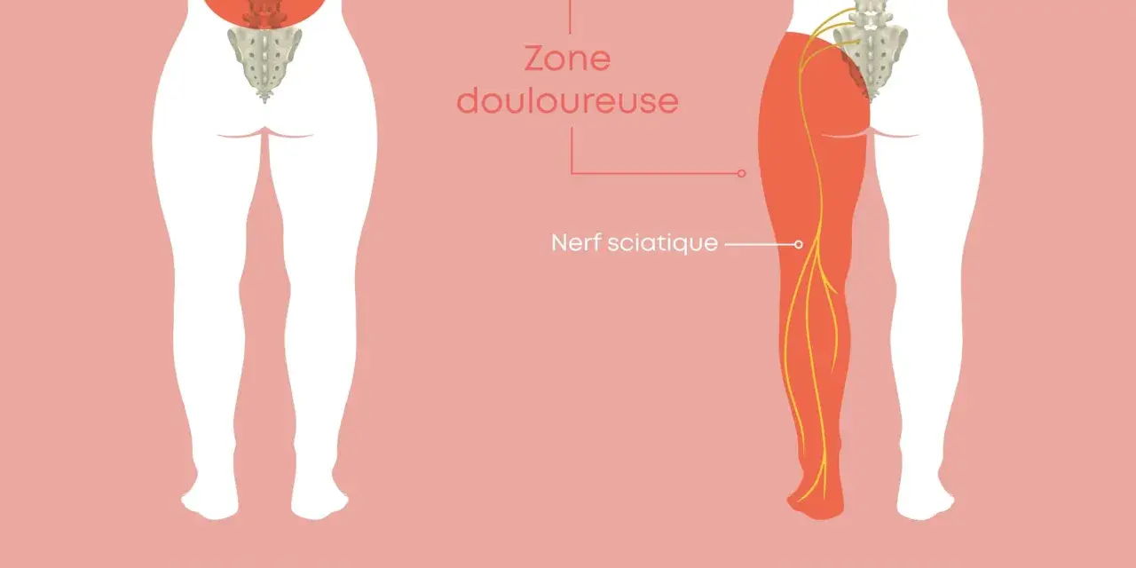 Illustration montrant le nerf sciatique et la zone douloureuse. Comprendre comment soigner une sciatique est essentiel pour retrouver le confort.