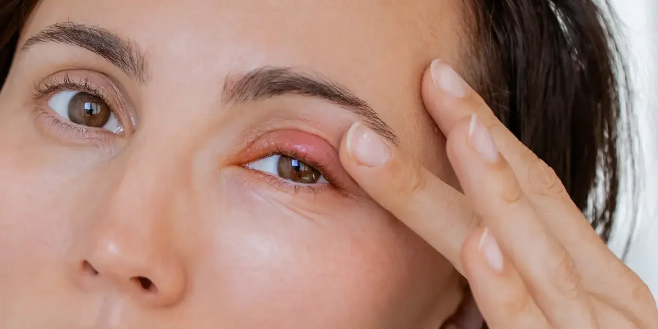 Un orgelet sur la paupière, peut-être causé par la fatigue, rend le regard moins vif.