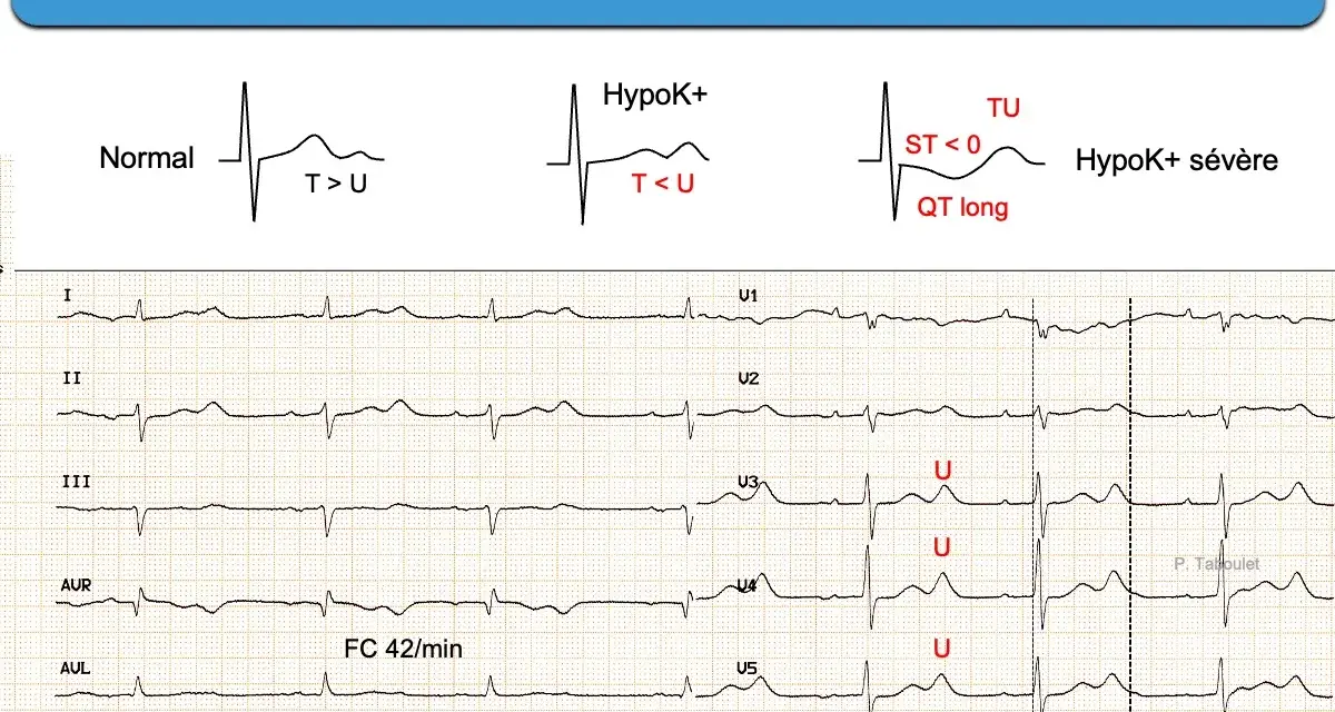 Électrocardiogramme montrant une hypokaliémie sévère avec onde U > T et QT long, signes d'un manque de potassium.