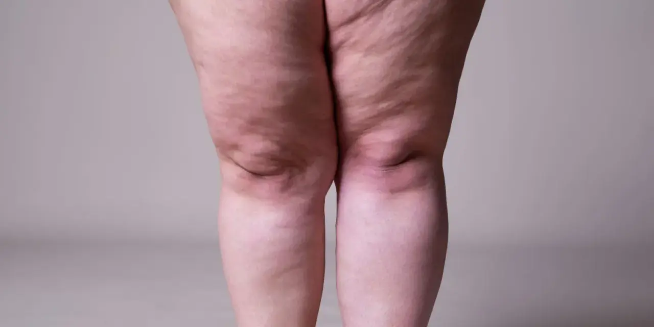 Jambes présentant des signes de lipœdème, évoquant la recherche d'un lipœdème traitement naturel.