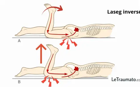 Lasegue inversé : mouvements à éviter pour la cruralgie. Le mouvement A accentue la douleur, le mouvement B est plus doux.