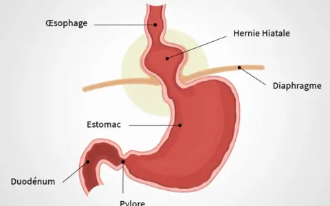 Schéma du diaphragme et de l'estomac montrant une hernie hiatale. Des remèdes de grand-mère peuvent aider à soulager les symptômes.