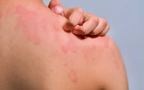 Une personne se gratte l'épaule couverte de plaques rouges, signe d'urticaire chaleur.
