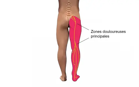 Schéma montrant les zones douloureuses principales dans la jambe et la cuisse, le long des nerfs sciatiques.