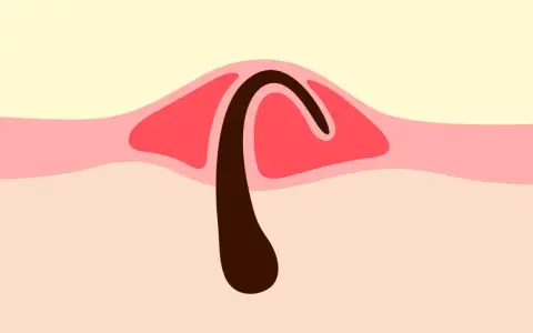 Illustration d'un poil incarné sous la peau, avec une partie foncée courbée sous une couche rose.