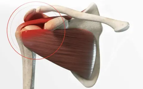 Anatomie de l'épaule montrant une tendinite. La zone rouge indique la douleur, suggérant un long temps de guérison.
