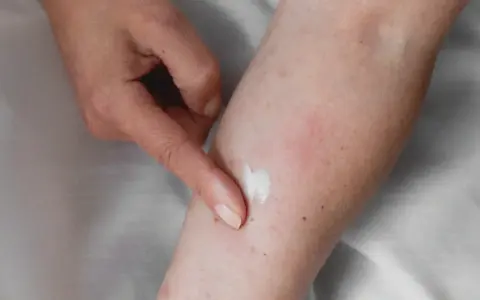 Application d'une crème apaisante sur une peau irritée, suggérant un urticaire traitement naturel.