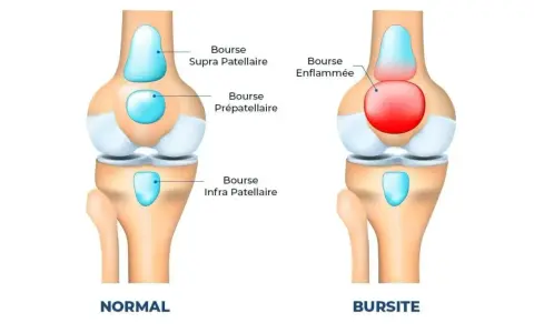 Comparaison d'un genou normal et d'un genou atteint de bursite. La bourse prépatellaire est enflammée et gonflée, causant un genou gonflé.