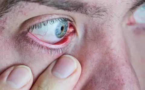 Gros plan sur un œil humain présentant un orgelet rouge sur la paupière. Une main touche doucement la zone, suggérant une recherche d'orgelet traitement naturel.