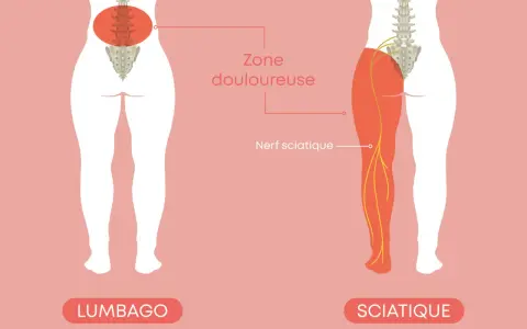 Illustration montrant le nerf sciatique et la zone douloureuse. Comprendre comment soigner une sciatique est essentiel pour retrouver le confort.