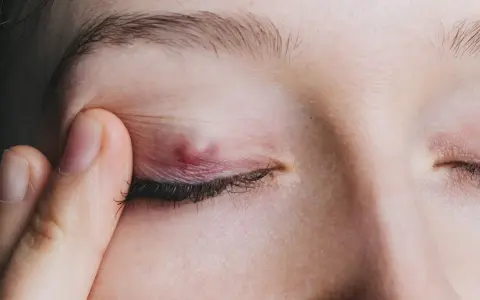 Un chalazion rouge et enflammé sur la paupière, causant une fatigue visuelle.