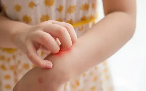 Main d'enfant se grattant le bras, une rougeur indiquant une piqûre de moustique qui gratte longtemps.