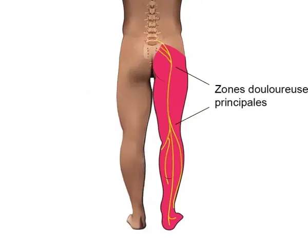 Schéma montrant les zones douloureuses principales dans la jambe et la cuisse, le long des nerfs sciatiques.