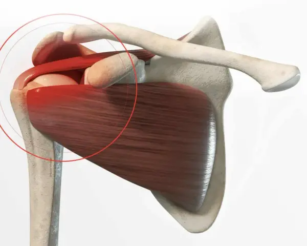 Anatomie de l'épaule montrant une tendinite. La zone rouge indique la douleur, suggérant un long temps de guérison.