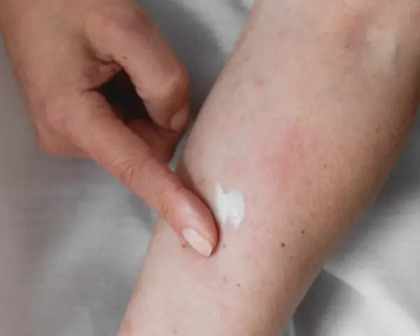 Application d'une crème apaisante sur une peau irritée, suggérant un urticaire traitement naturel.