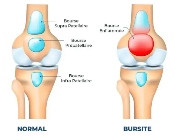 Comparaison d'un genou normal et d'un genou atteint de bursite. La bourse prépatellaire est enflammée et gonflée, causant un genou gonflé.