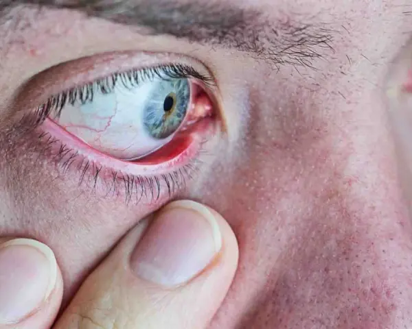 Gros plan sur un œil humain présentant un orgelet rouge sur la paupière. Une main touche doucement la zone, suggérant une recherche d'orgelet traitement naturel.