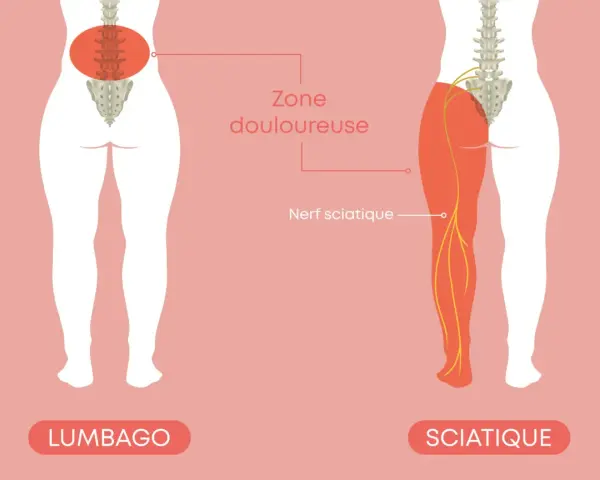 Illustration montrant le nerf sciatique et la zone douloureuse. Comprendre comment soigner une sciatique est essentiel pour retrouver le confort.