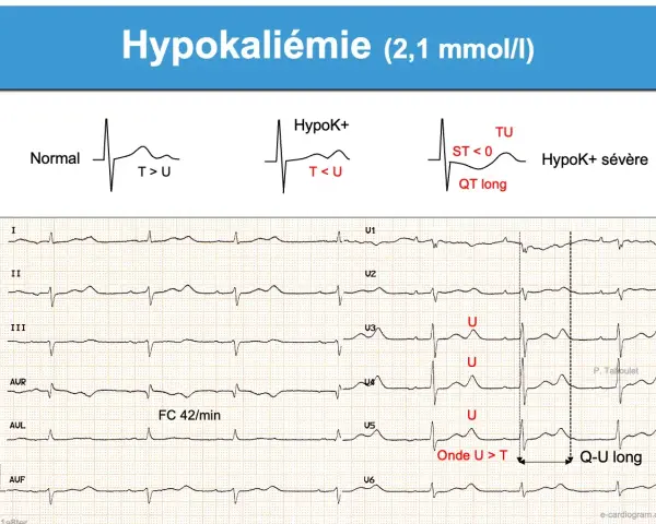 Électrocardiogramme montrant une hypokaliémie sévère avec onde U > T et QT long, signes d'un manque de potassium.