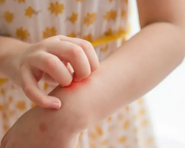 Main d'enfant se grattant le bras, une rougeur indiquant une piqûre de moustique qui gratte longtemps.