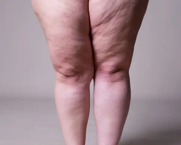 Jambes présentant des signes de lipœdème, évoquant la recherche d'un lipœdème traitement naturel.