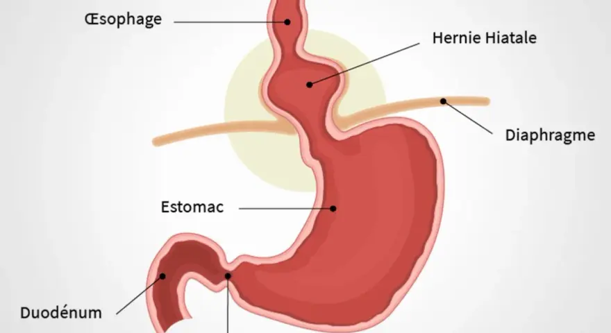 Schéma du diaphragme et de l'estomac montrant une hernie hiatale. Des remèdes de grand-mère peuvent aider à soulager les symptômes.