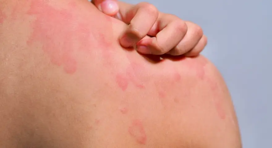 Une personne se gratte l'épaule couverte de plaques rouges, signe d'urticaire chaleur.