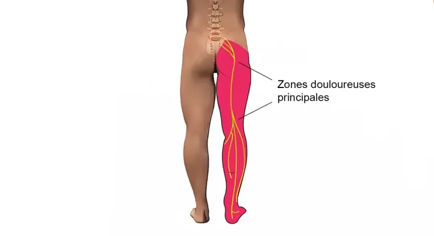 Schéma montrant les zones douloureuses principales dans la jambe et la cuisse, le long des nerfs sciatiques.