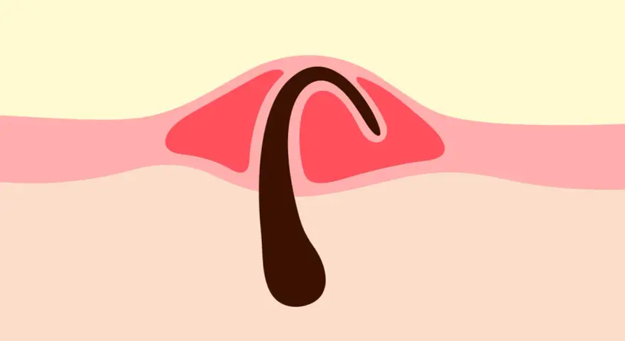 Illustration d'un poil incarné sous la peau, avec une partie foncée courbée sous une couche rose.