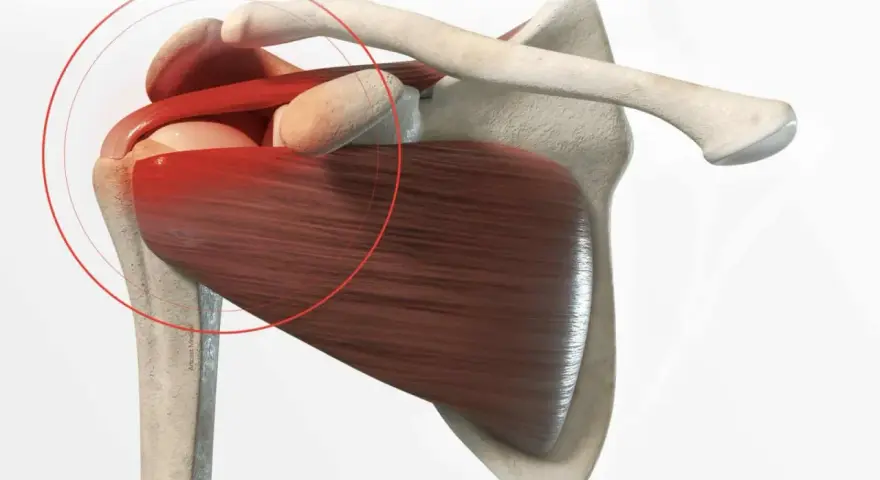 Anatomie de l'épaule montrant une tendinite. La zone rouge indique la douleur, suggérant un long temps de guérison.