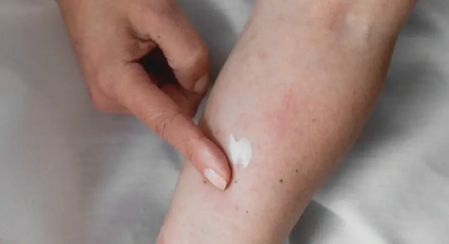 Application d'une crème apaisante sur une peau irritée, suggérant un urticaire traitement naturel.